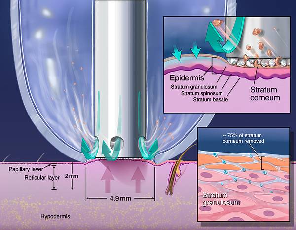 Bei der DermoLissage Methode werden diese Hornzellen durch medizinische Qualitätsdiamanten mit hoher Präzision abgetragen. | RPM Medical & Kosmetik Rafael-Peter Mischewski Mönchengladbach
