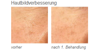 Vorher-/Nachher-Bilder Hautverbesserung mit LDM®-Sonoskin | RPM Medical & Kosmetik Rafael-Peter Mischewski Mönchengladbach