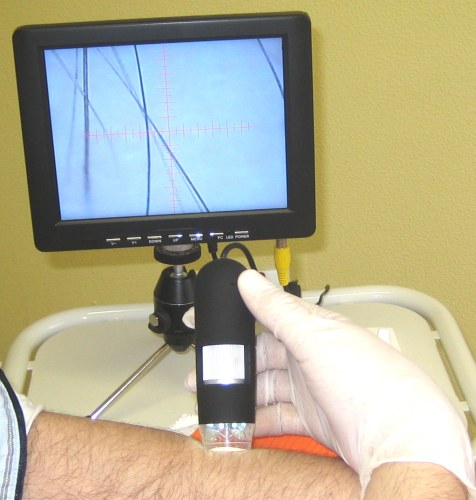 Analyse für IPL-Behandlung dauerhafte Haarentfernung mittels Video-Hand-Mikroskop | RPM Medical & Kosmetik Rafael-Peter Mischewski Mönchengladbach