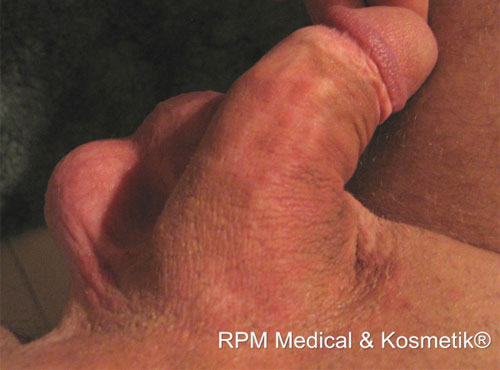 Sie sehen hier ein Zwischenergebnis (nach ca. 2 - 3 Behandlungen). | RPM Medical & Kosmetik Rafael-Peter Mischewski Mönchengladbach