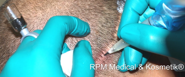 Behandlung Mikro-Haar-Pigmentierung mit der Point-Touch-Methode | RPM Medical & Kosmetik Rafael-Peter Mischewski Mönchengladbach