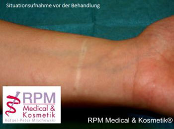 Narbenretuschierung-Camouflagepigmentierung 1: Situationsaufnahme vor der Behandlung | RPM Medical & Kosmetik Rafael-Peter Mischewski Mönchengladbach