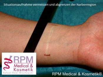 Narbenretuschierung-Camouflagepigmentierung 2: Situationsaufnahme vermessen und abgrenzen der Narbenregion | RPM Medical & Kosmetik Rafael-Peter Mischewski Mönchengladbach
