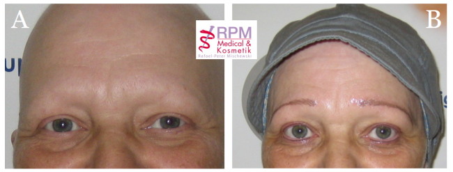 Bild A = vor der Behandlung, Bild B = direkt nach der Behandlung | RPM Medical & Kosmetik Rafael-Peter Mischewski Mönchengladbach